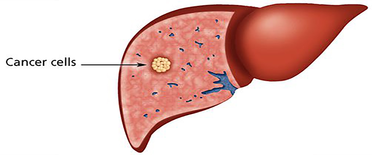7d7eff47-how-when-and-why-does-liver-gets-affected-what-are-its-symptoms 