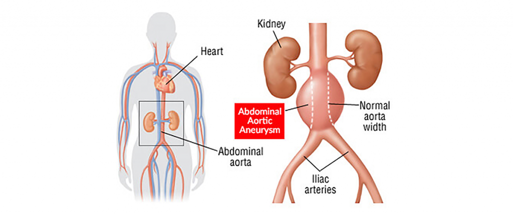 Aortic Aneurysm Surgery Dr Abhilash
