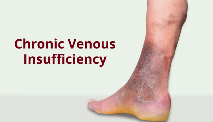 chronic venous insufficiency